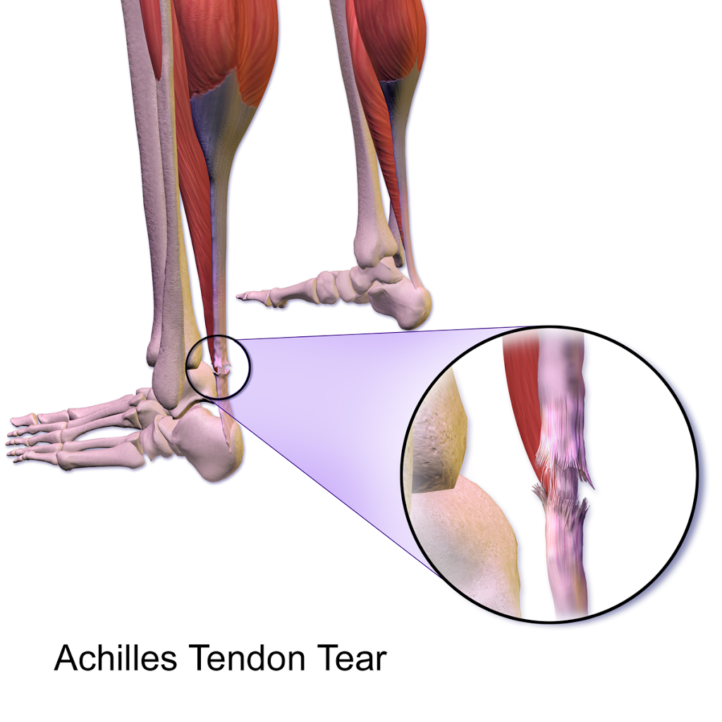 Achilles and His Tendon | Chicago DPM